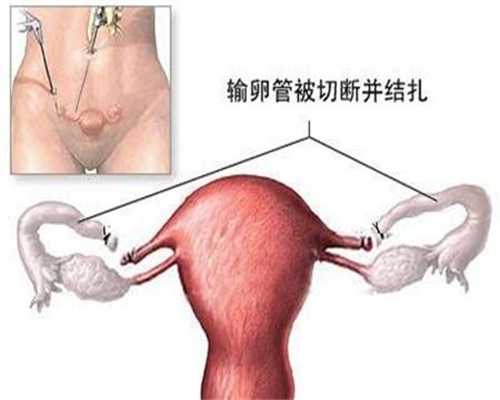 多年的多囊卵巢综合征输卵管双侧通不畅，试管