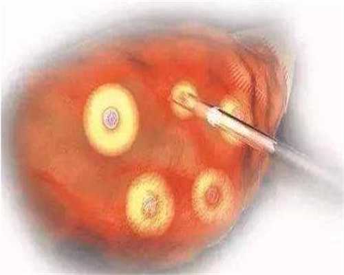 无锡捐卵的方式,泰国试管过程如何避免卵巢过度刺激综合征_1